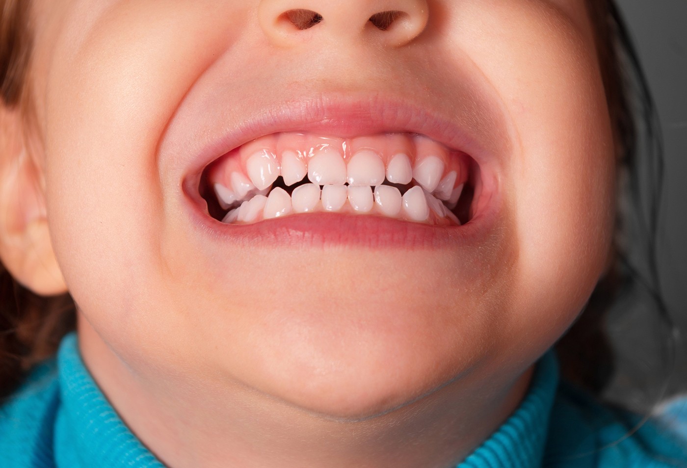 Zirconia crowns