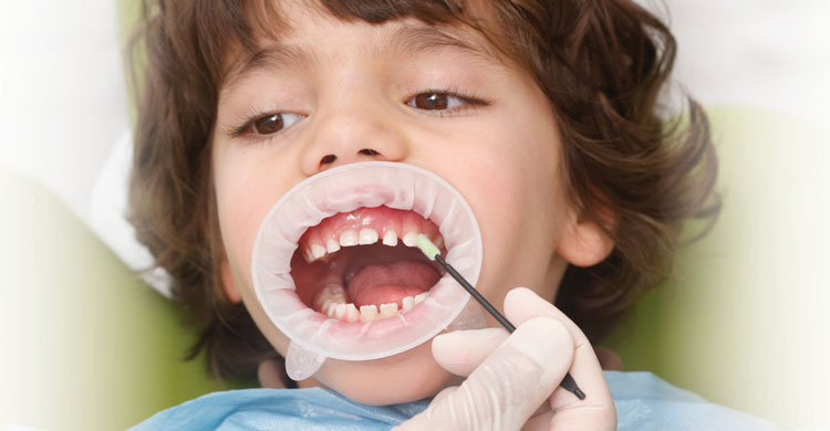 Fluoride varnish