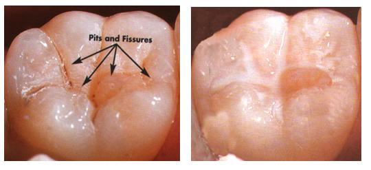 Pit and fissure sealants