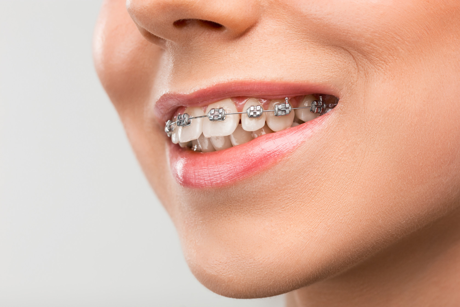 Metal braces Adult