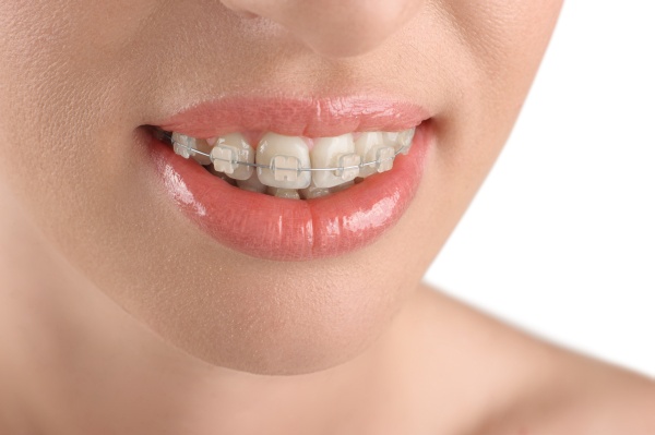 Ceramic braces Adult