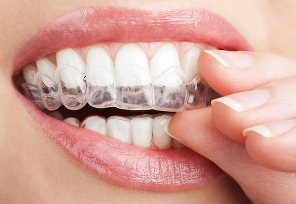 Clear aligners Adult