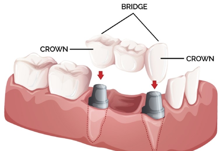 Crown and Bridge