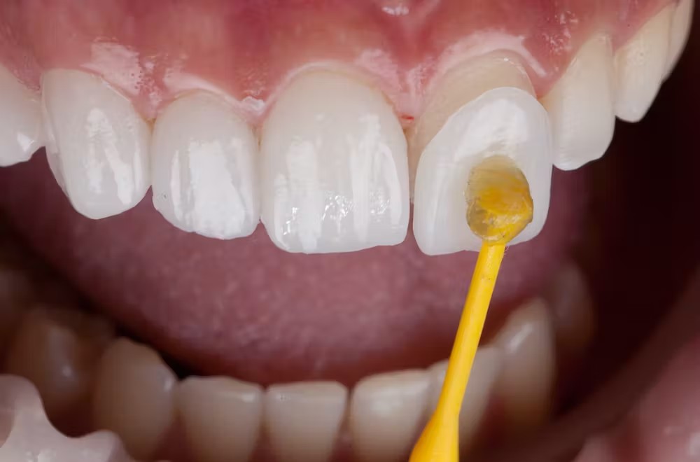 Veneers