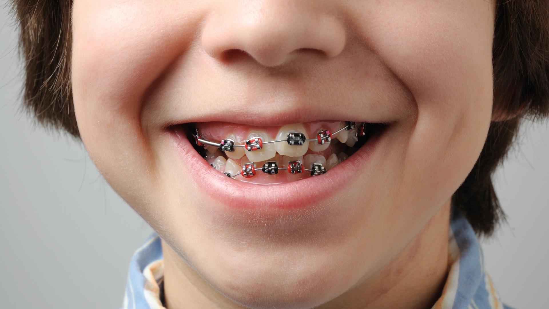 Braces