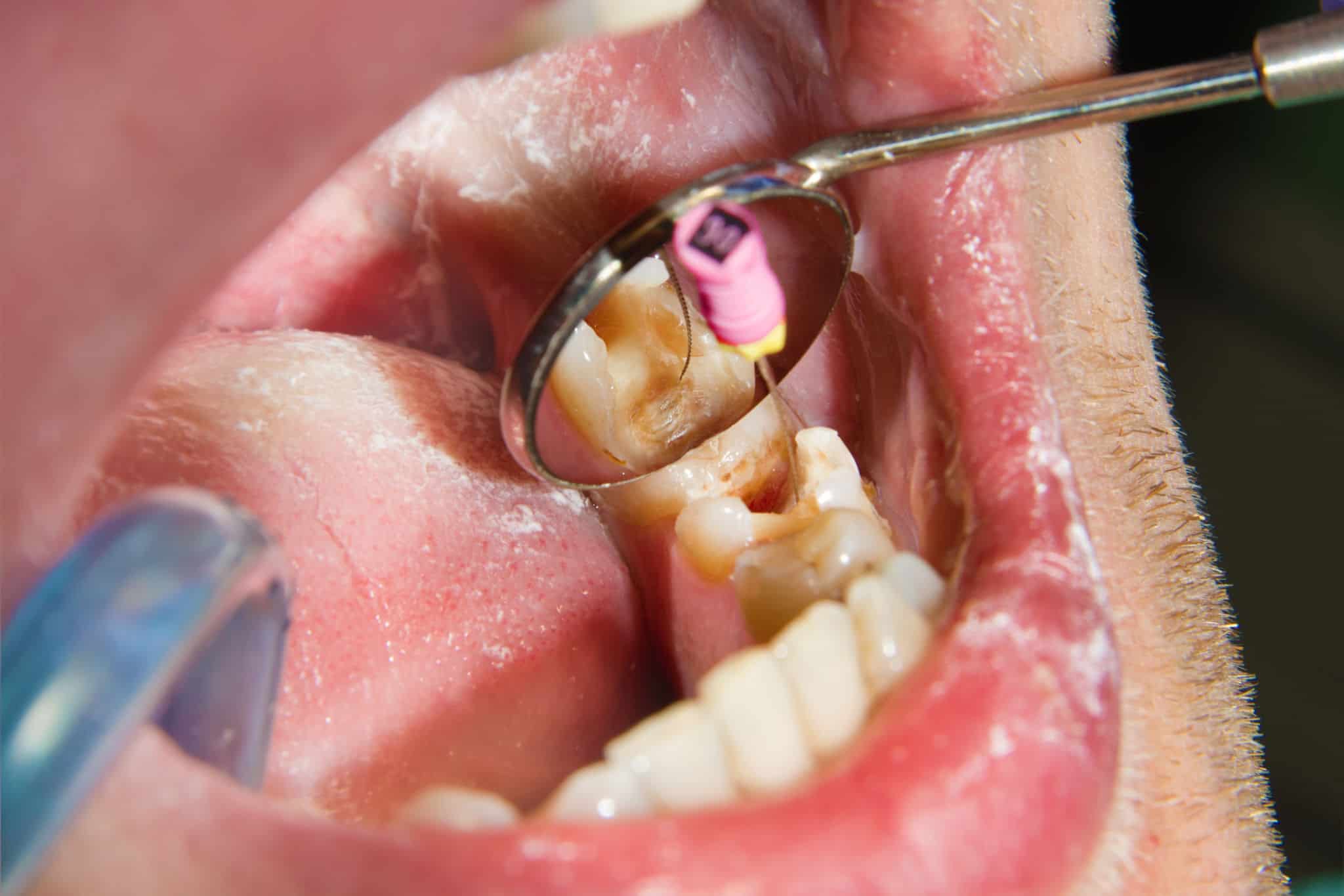Root canal treatment