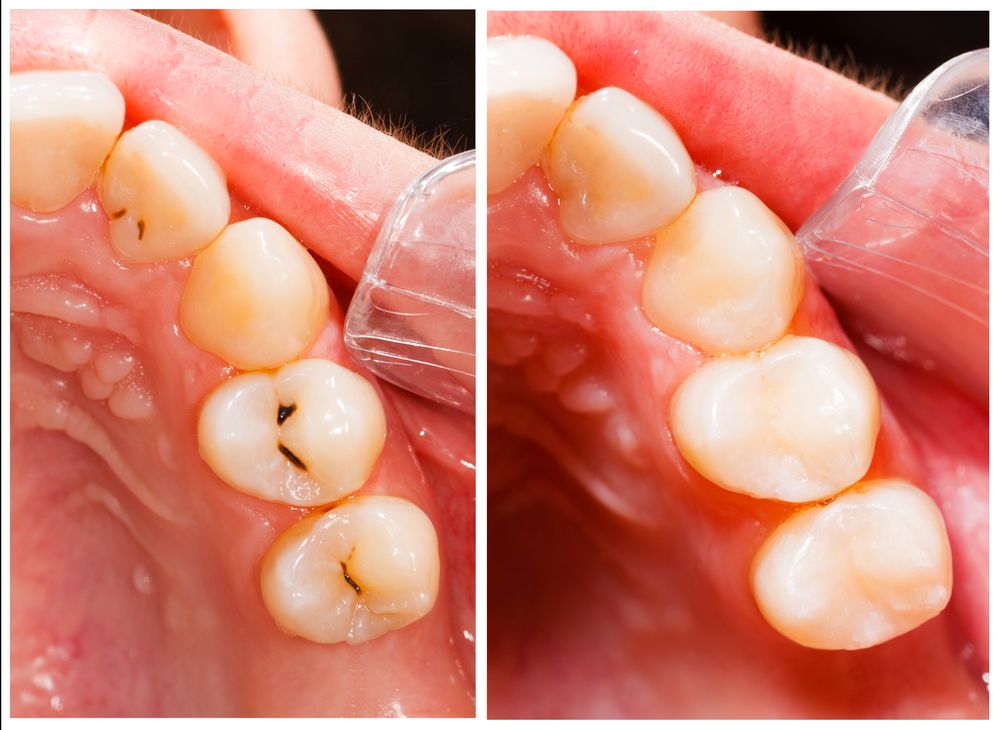 Tooth-colored fillings