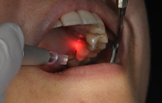 Laser treatment Adult
