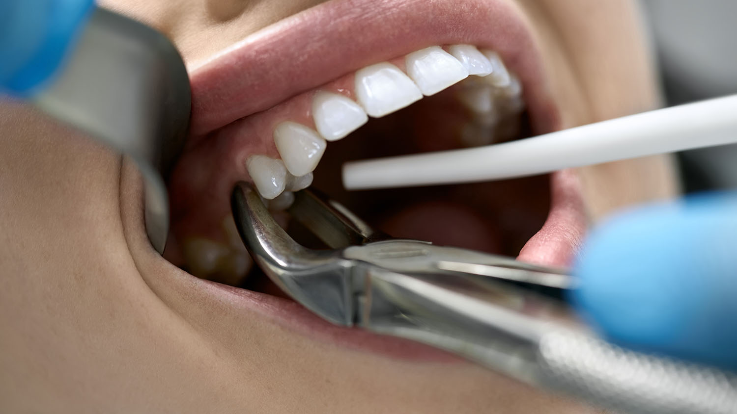 Tooth extractions
