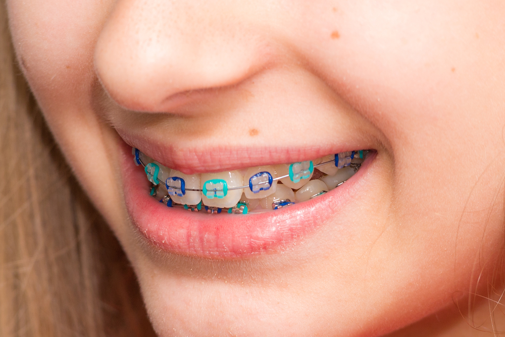 Ceramic braces