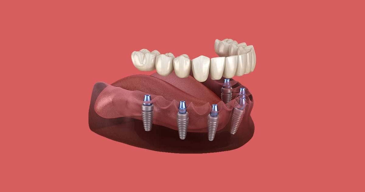 Dental implants